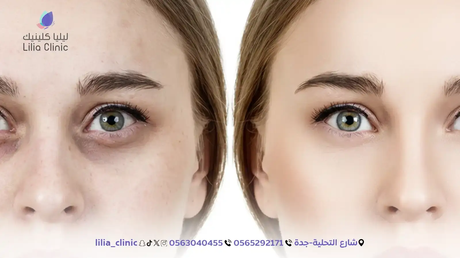 4 طرق فعالة لعلاج الهالات السوداء واستعادة نضارة العين في جدة