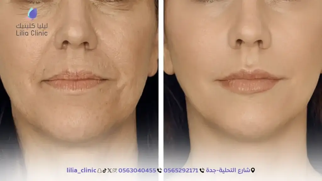 5 تقنيات لشد الوجه بدون جراحة في جلسة واحدة بجدة
