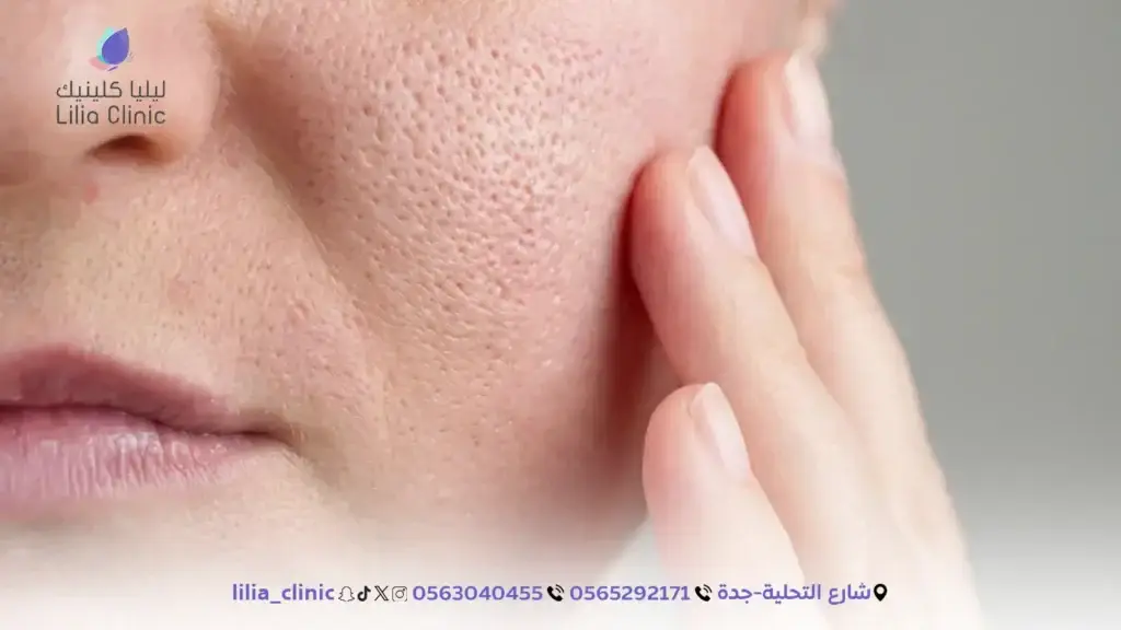 7 نصائح ذهبية للعناية بالبشرة الدهنية ومنع ظهور المسام في جدة