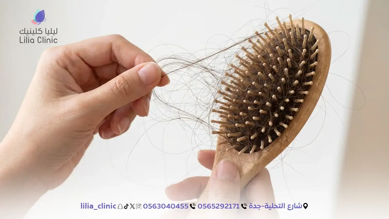 أقوى 5 علاجات طبية لوقف تساقط الشعر الوراثي نهائياً في جدة